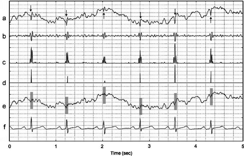 ECG Artifacts