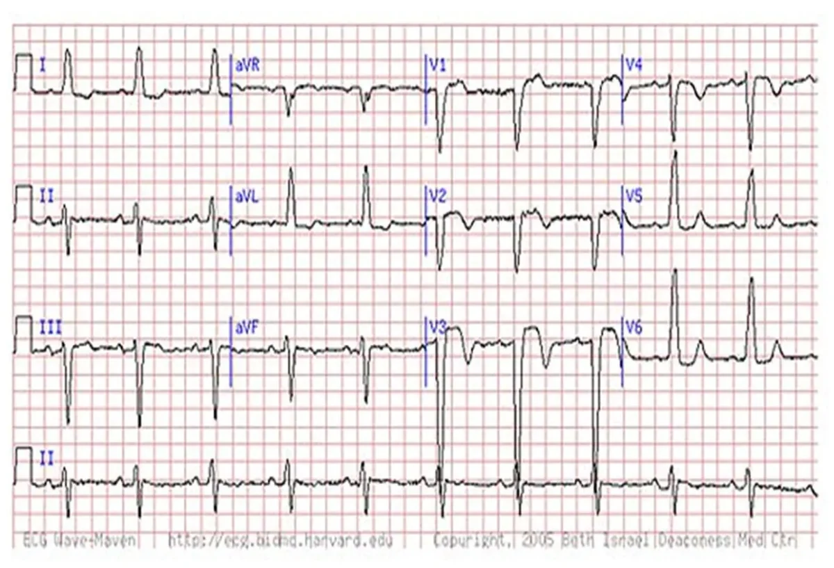 ECGs in Acute Myocardial Infarction