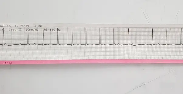 Second-Degree AV Block Type I Recognizing the Signs and Symptoms
