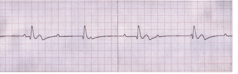 pulseless electrical activity