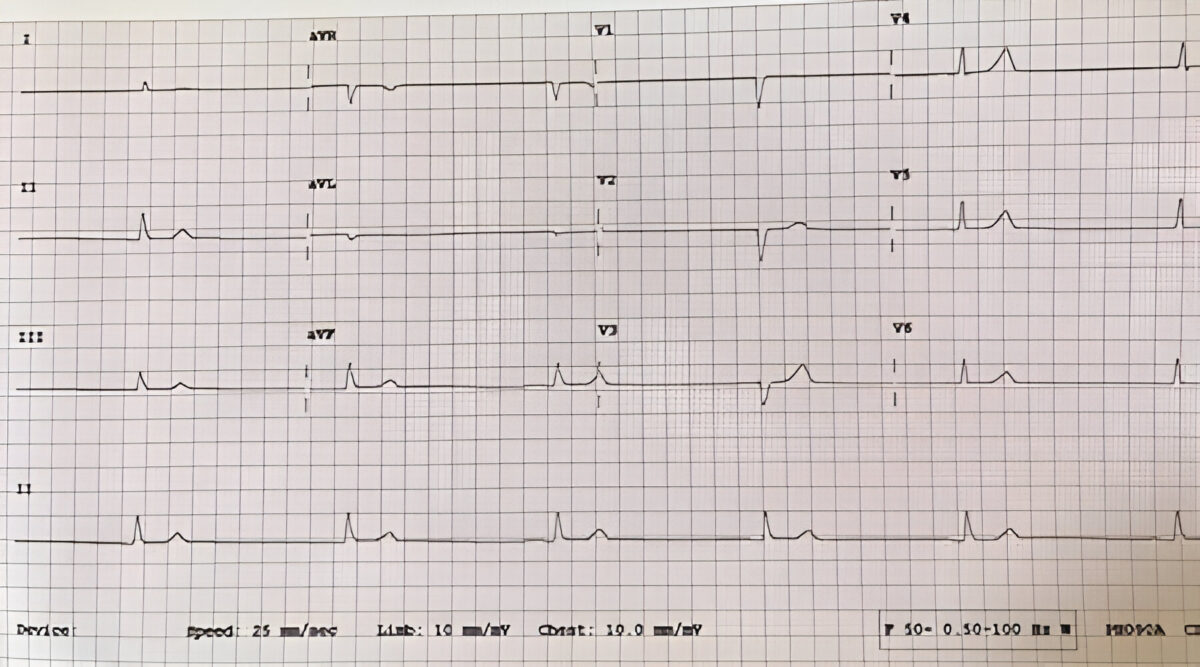 Sinus Bradycardia