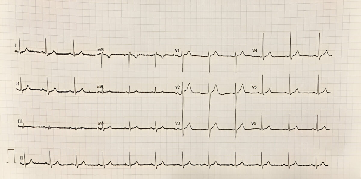 VF And Pulseless VT