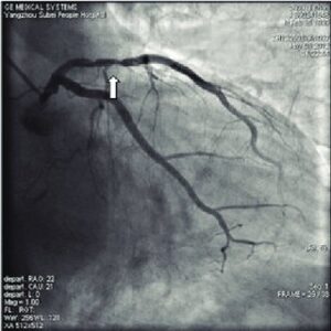 An image showing the 70% blockage of coronary artery